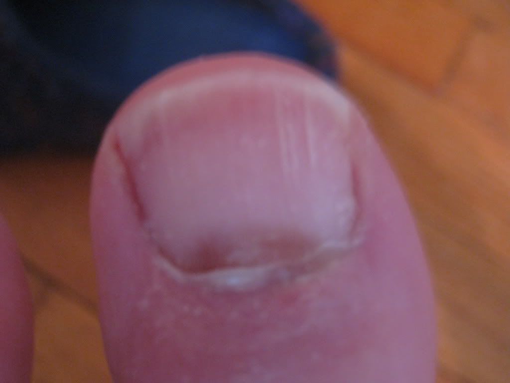 Hammertoe