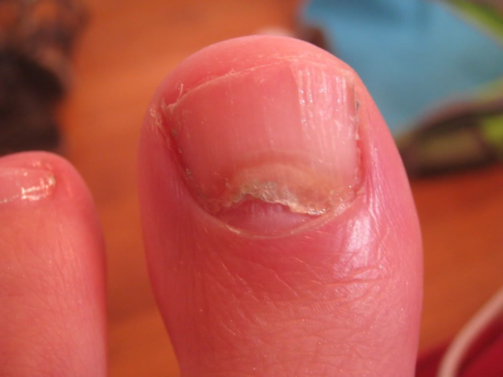 toenail lifting off nail bed