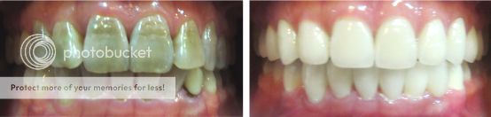 răng bị nhiễm Tetracycline